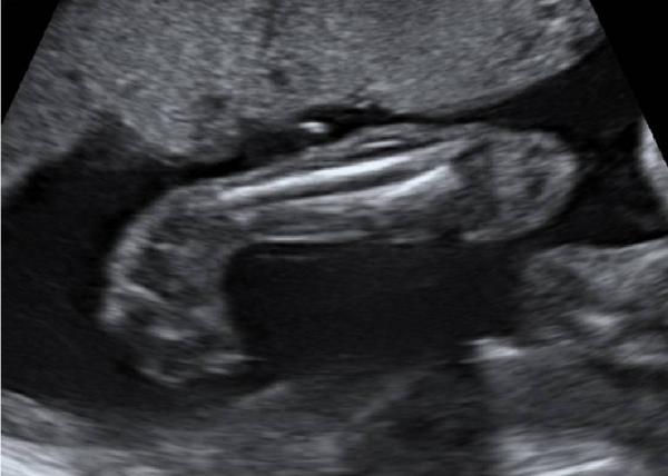 foto n. 2 immagine ecografia prenatale