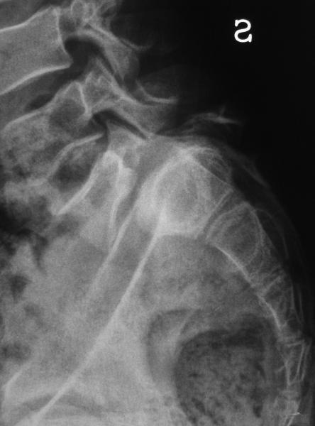 Figura 2: Spondilolistesi di 3° di L5 sul sacro in una paziente di 15 anni. Uno scivolamento di questa gravità comporta un cospicuo accorciamento del diametro antero-posteriore del canale del parto.