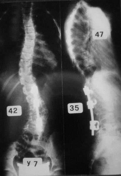 Figura 3: Artrodesi vertebrale estesa fino a L4 nel trattamento di una scoliosi congenita. La riduzione dell’articolarità in flesso-estensione del rachide lombare potrebbe costituire una indicazione relativa al taglio cesareo.